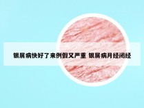 银屑病快好了来例假又严重 银屑病月经闭经