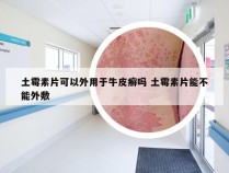 土霉素片可以外用于牛皮癣吗 土霉素片能不能外敷