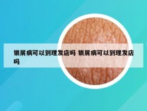 银屑病可以到理发店吗 银屑病可以到理发店吗