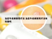 治愈牛皮癣割耳疗法 治愈牛皮癣割耳疗法有效果吗