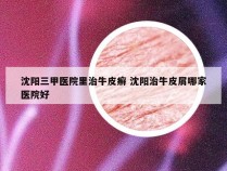 沈阳三甲医院里治牛皮癣 沈阳治牛皮屑哪家医院好