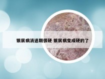 银屑病消退期很硬 银屑病变成硬的了