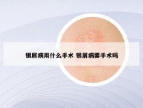银屑病用什么手术 银屑病要手术吗