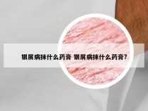 银屑病抹什么药膏 银屑病抹什么药膏?