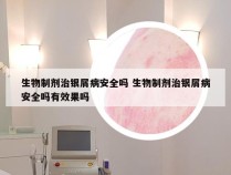 生物制剂治银屑病安全吗 生物制剂治银屑病安全吗有效果吗