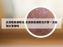 点滴银屑病照光 点滴银屑病照光疗第一次会发红发痒吗