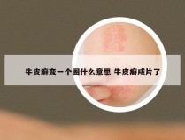 牛皮癣变一个圈什么意思 牛皮癣成片了