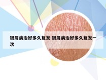 银屑病治好多久复发 银屑病治好多久复发一次