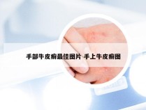 手部牛皮癣最佳图片 手上牛皮癣图
