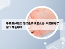 牛皮癣掉后出现红色条纹怎么办 牛皮癣好了留下白色印子