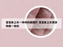 宝宝身上长一块块的癣图片 宝宝身上长很多块癣一样的