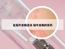 乱贴牛皮癣违法 贴牛皮癣的膏药