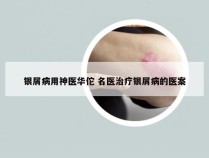 银屑病用神医华佗 名医治疗银屑病的医案