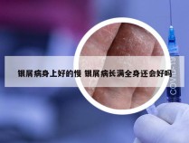 银屑病身上好的慢 银屑病长满全身还会好吗