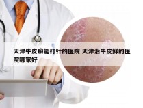 天津牛皮癣能打针的医院 天津治牛皮鲜的医院哪家好