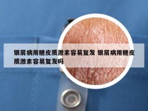 银屑病用糖皮质激素容易复发 银屑病用糖皮质激素容易复发吗