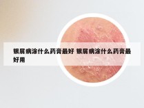 银屑病涂什么药膏最好 银屑病涂什么药膏最好用