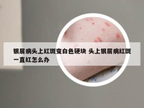 银屑病头上红斑变白色硬块 头上银屑病红斑一直红怎么办