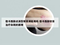 他卡西醇点滴型银屑病能用吗 他卡西醇软膏治疗白斑的原理