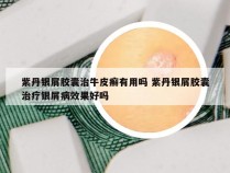 紫丹银屑胶囊治牛皮癣有用吗 紫丹银屑胶囊治疗银屑病效果好吗