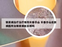 银屑病治疗治疗推荐长春华山 长春华山皮肤病医院治银屑病能去根吗