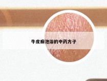牛皮癣泡浴的中药方子