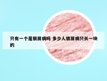 只有一个是银屑病吗 多少人银屑病只长一块的