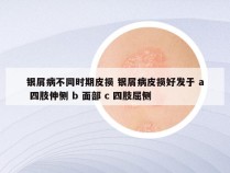 银屑病不同时期皮损 银屑病皮损好发于 a 四肢伸侧 b 面部 c 四肢屈侧