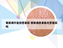 银屑病不能放葱姜蒜 银屑病患者能吃葱姜蒜吗