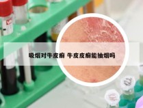 吸烟对牛皮癣 牛皮皮癣能抽烟吗