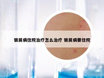 银屑病住院治疗怎么治疗 银屑病要住院
