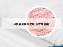 6岁宝贝长牛皮癣 六岁牛皮癣