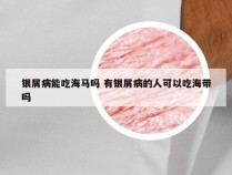 银屑病能吃海马吗 有银屑病的人可以吃海带吗