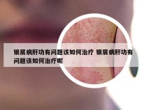银屑病肝功有问题该如何治疗 银屑病肝功有问题该如何治疗呢