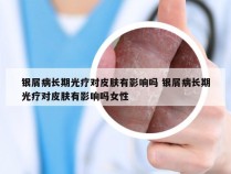 银屑病长期光疗对皮肤有影响吗 银屑病长期光疗对皮肤有影响吗女性