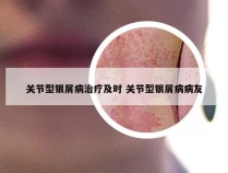 关节型银屑病治疗及时 关节型银屑病病友