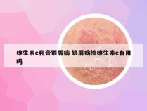 维生素e乳膏银屑病 银屑病擦维生素e有用吗