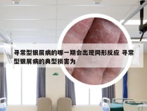 寻常型银屑病的哪一期会出现同形反应 寻常型银屑病的典型损害为