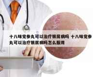 十八味党参丸可以治疗银屑病吗 十八味党参丸可以治疗银屑病吗怎么服用