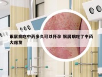 银屑病吃中药多久可以怀孕 银屑病吃了中药大爆发