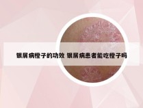 银屑病橙子的功效 银屑病患者能吃橙子吗