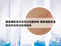 银屑病性关节炎可以吃腊肉吗 银屑病类风湿性关节炎可以吃鸡肉吗