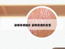 副银屑病猫扑 副银屑病的危害
