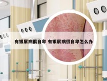 有银屑病很自卑 有银屑病很自卑怎么办