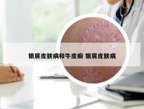 银屑皮肤病和牛皮癣 银屑皮肤病