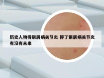 历史人物得银屑病关节炎 得了银屑病关节炎有没有未来