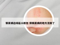 银屑病边缘起小脓包 得银屑病的地方流脓了