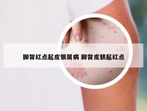 脚背红点起皮银屑病 脚背皮肤起红点