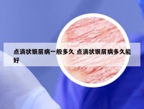 点滴状银屑病一般多久 点滴状银屑病多久能好