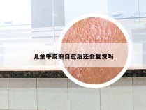 儿童牛皮癣自愈后还会复发吗